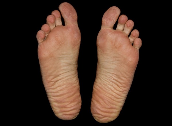 split skin between toes not athlete's foot